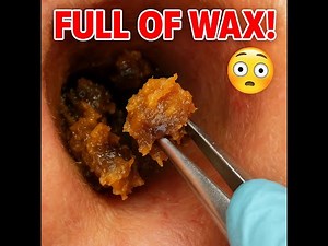 So Satisfying! Ear Full of Wax – Pulled Out in Big Chunks