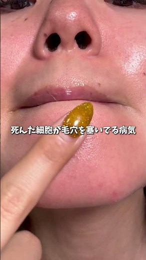 毛孔性角化症になりやすい人特徴3選はコレ❣️#キテン #レチノール #垢抜け #PR