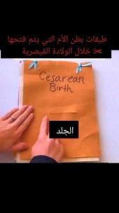 1.5M views · 5.6K reactions | مراحل الولادة القيصرية #مراحل...