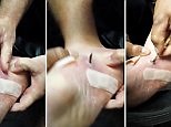 Man pulls shocking MONSTER splinter from his foot