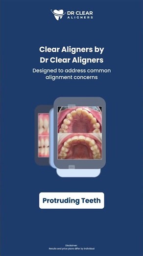 Can Clear Aligners Fix Gaps & Crooked Teeth? 🦷✨