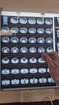 Kidney damage due to kidney and ureter stones-Obstructive Uropathy#viral #wedding #trending