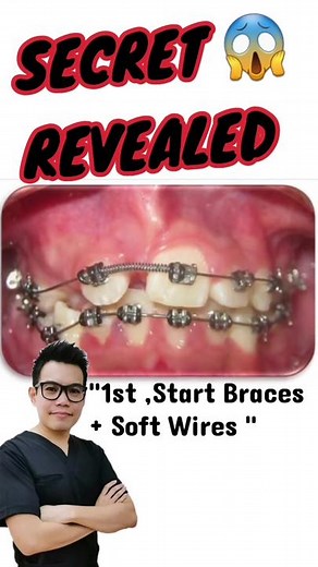 Effective Tips for Open Coil Spring Braces Progress and Usage