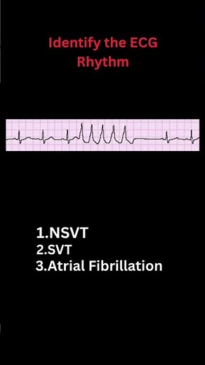 🫀Test your ECG skills in 15 seconds 👨‍⚕ #ecg #dailyceg #medical #shorts