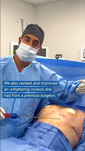 Fat Transfer to Breast with Dr. Zuri in Miami | Zuri Plastic Surgery