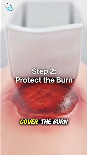 First Aid for Burns: What You Should Do Immediately