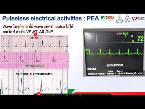 Pulseless Electrical Activity (PEA)