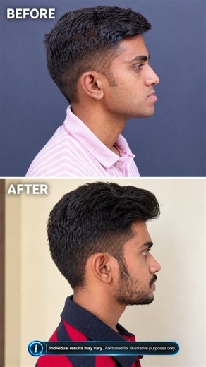 Jaw Surgery in Kerala | Complex Orthognathic Surgery Before & After | Dr Mathew PC #drmathewpc