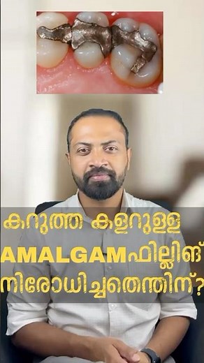 Silver amalgam fillings: A blend of tradition and controversy in modern dentistry.