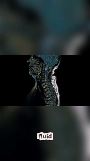 (ch16.4)Meninges, Blood Vessels & Cerebrospinal Fluid | CNS Protection