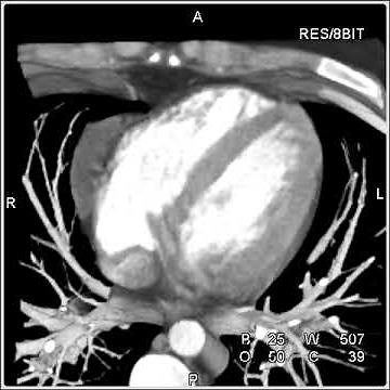 Cardiac: Pericardial Cyst (2 of 2)