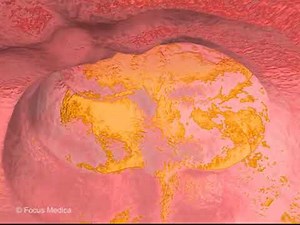 Ulcerative Colitis - Animated Atlas