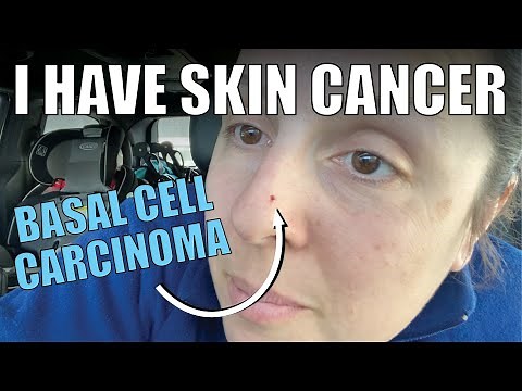 I HAVE SKIN CANCER | Basal Cell Carcinoma | signs, what it looks like, biopsy, treatment plan