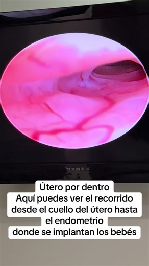 Fecundación in Vitro: Recorrido por el Útero