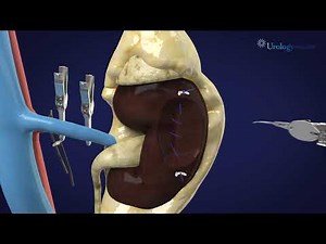 Robot-Assisted Partial Nephrectomy for Kidney Cancer and Benign Kidney Tumors
