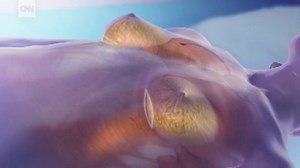 Nine deaths from a rare cancer have been linked to breast implants, FDA reports http://cnn.it/2msIRTC | CNN