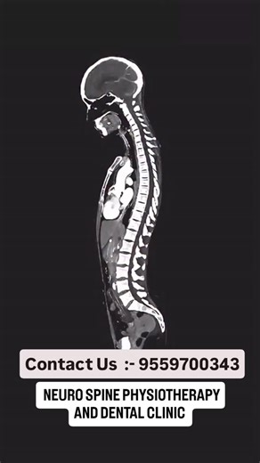 DR.VIKAS PANDEY (PT) on Instagram: "🔵 Cupping Therapy Cupping Therapy is a therapeutic technique used in physiotherapy and traditional medicine where special cups (glass, silicone, or plastic) are placed on the skin to create suction. This suction improves blood circulation and helps relieve muscle tension and pain. ✅ Benefits of Cupping Therapy Relieves muscle pain and stiffness Effective for Neck pain & Cervical spondylosis Helps reduce Neck hump (Buffalo hump) Useful in Frozen shoulder Sciat
