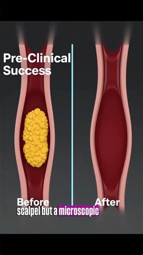 Nanobots clear artery plaque in minutes—this breakthrough could replace risky heart surgeries ❤️🧬