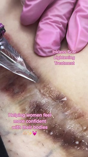 This client has a thick dark scar from a tummy tuck surgery that didnt heal correctly. We love helping women love their bodies more! 💓🫶🏻✨#permanentmakeup #permanentmakeupflorida #paramedicaltattoo #surgicalscarcoverup