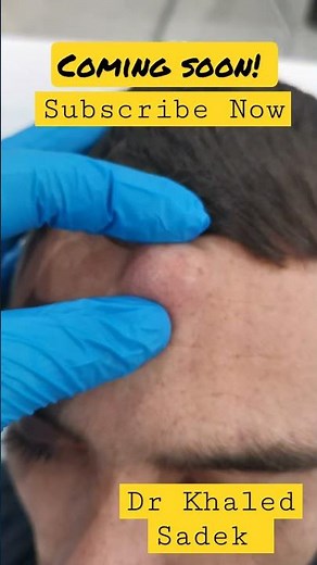 massive forehead cyst. Dr Khaled Sadek #drkhaledsadek #blackheads #cystremoval