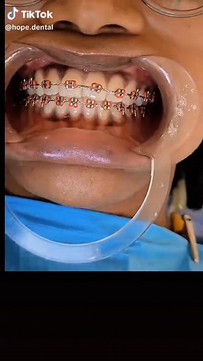 Braces Progression: 8 Months of Teeth Alignment