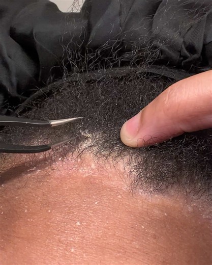 Tweezer pick ‼️‼️‼️#psoriasis #flakes #dandruff #viral #itchyscalp