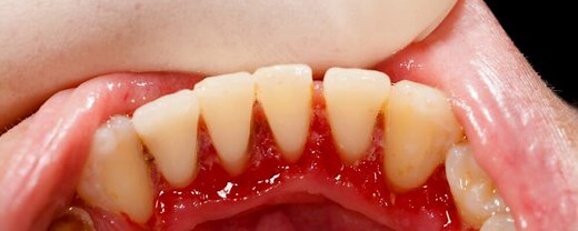 Gingivectomie : les causes et techniques de la procédure