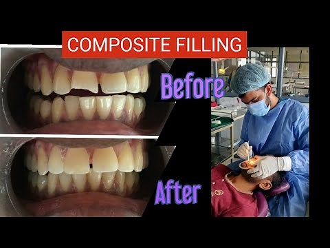 Composite Restoration on teeth with Ellis Class II Fracture | Dr Aparna| Dr Ambili |
