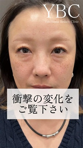 Witness the shocking transformation #DarkCircleRemoval #Beauty #UnderEyeDarkCircles #PlasticSurge...