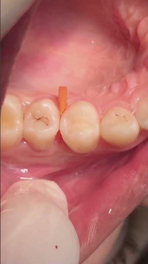 Class II Composite restoration for first premolar tooth #dentist