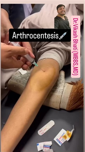 Dr. Vikash Bhati 🩺 on Instagram: "Arthrocentesis💉 Knee arthrocentesis is a minor surgical procedure that involves extracting synovial fluid from the knee joint using a needle and syringe. It can be used for diagnosis and treatment. #arthrocentesis #MedicalEducation #Healthcare #MedicalVideo #Medicine #MedicalTraining #Surgery #Anatomy #Pharmacology #Pathology #Pediatrics #Cardiology #Dermatology #viral #viralreelsvideo❤️ #drvikashbhati #explore #ortho #orthopedics"