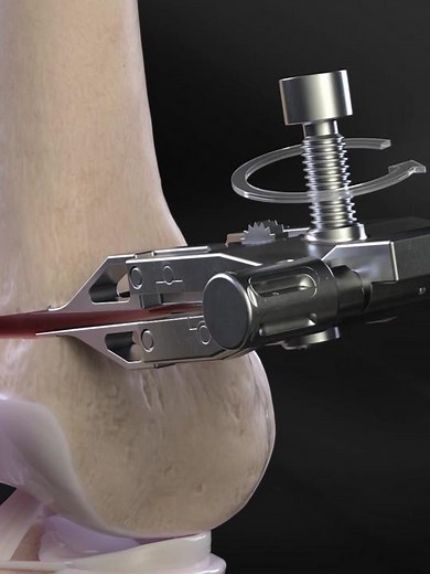 Distal Femoral Osteotomy Surgery Explained in 3D Animation
