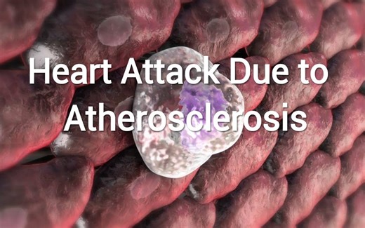 【医学动画】动脉粥样硬化的形成过程