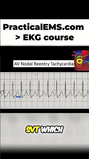 SVT Explained Simply: AVNRT vs. AVRT Differences