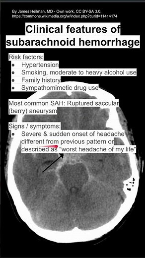 Clinical features of subarachnoid hemorrhage