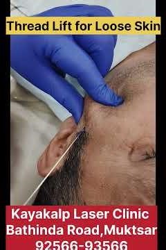 Thread Lift Treatment Results Single Session.