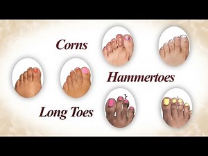 Corns, Hammertoes, Long Toes - Keyes for Toes