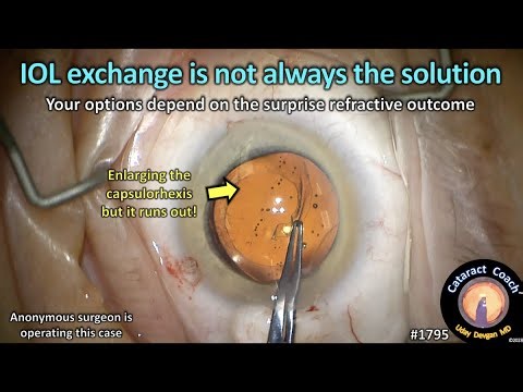 CataractCoach™1795: IOL exchange is not always the solution
