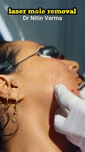 Advanced laser Mole Removal Technique | Scarless Mole Removal 5