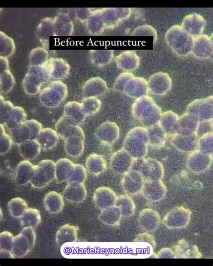 15K views · 633 reactions |  SHARE this one! More evidence based Acupuncture is emerging daily! This is another one confirming we practice an amazing medicine! Thank you @mariereynolds_mrl for creating this one incredible video.  #acupuncturist #chinesemedicineworks #acupuncturebenefits #acupuncturerocks #acupunctureheals | AcuPro Academy | Facebook