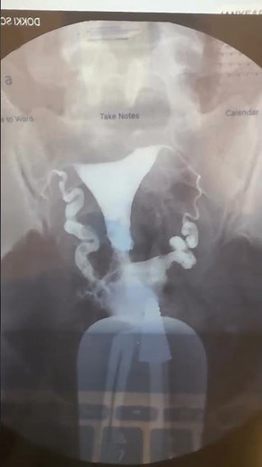 Asherman syndrome miracle