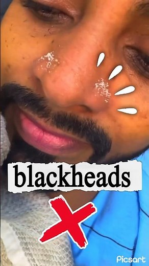 Blackhead removal guide: painless extraction method plus daily routine to stop blackheads returning