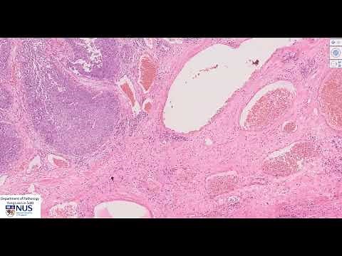 Bladder: Papillary urothelial carcinoma Microscopy - Talking slide