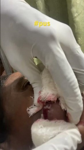 Pus removal from buccal cyst. #pus #cyst #pimple