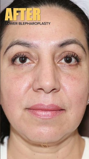 Before & After | Blepharoplasty Results!