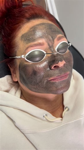 ✨ Hollywood Laser Carbon Peel | Hollywood Spectra ✨ 🖤 Step 1: Carbon Application Heating Phase A medical-grade carbon mask is applied to the skin and gently heated. This allows the carbon to melt deeper into the pores, binding to oil, debris, and impurities beneath the surface. ⚡ Step 2: Laser Activation Using the Hollywood Spectra laser, we precisely target the carbon particles. The laser energy breaks down and vaporizes the carbon from the skin. 🧼 Step 3: Deep Pore Detox Exfoliation As the c