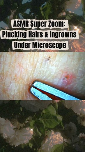 ASMR Super Zoom: Plucking Hairs & Ingrowns Under Microscope