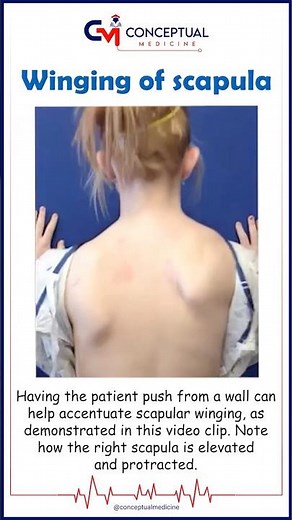 Winging of Scapula (Demonstration) 😱 High-Yield USMLE Anatomy