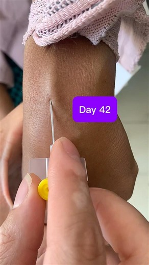 How to Insert a 24G Yellow IV Cannula on a Prominent Vein | Day 42 Clinical Skills#shorts #safi