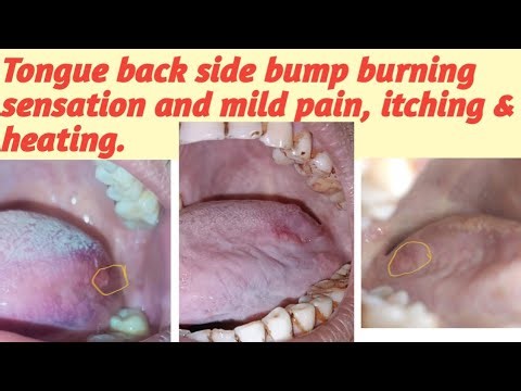 Tongue back side bump.Tongue back side elevation burning sensation and mild pain, itching & heating.